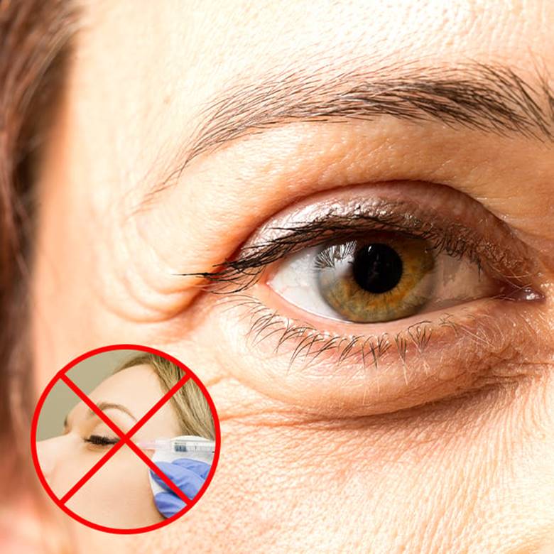 Không Cần Botox Vẫn Mờ Vết Chân Chim? Bác Sĩ Da Liễu Tiết Lộ Bí Quyết