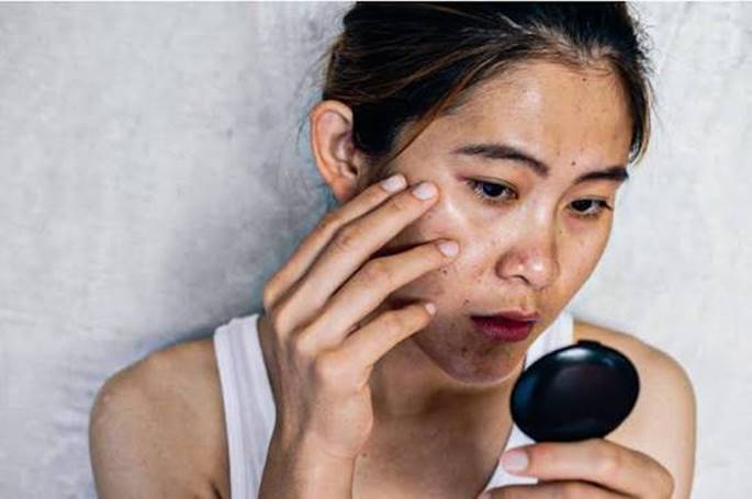 Nguyên nhân khiến làn da xỉn màu, thiếu sức sống
